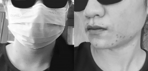 Jerawat pada wajah yang timbul akibat penggunaan masker